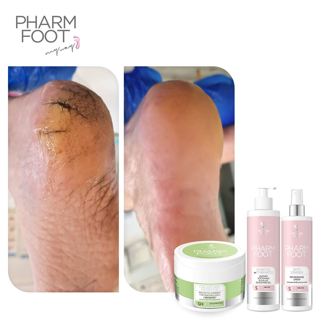 PHARM FOOT Komplekts saplaisājušu papēžu un pēdu ādas kopšanai