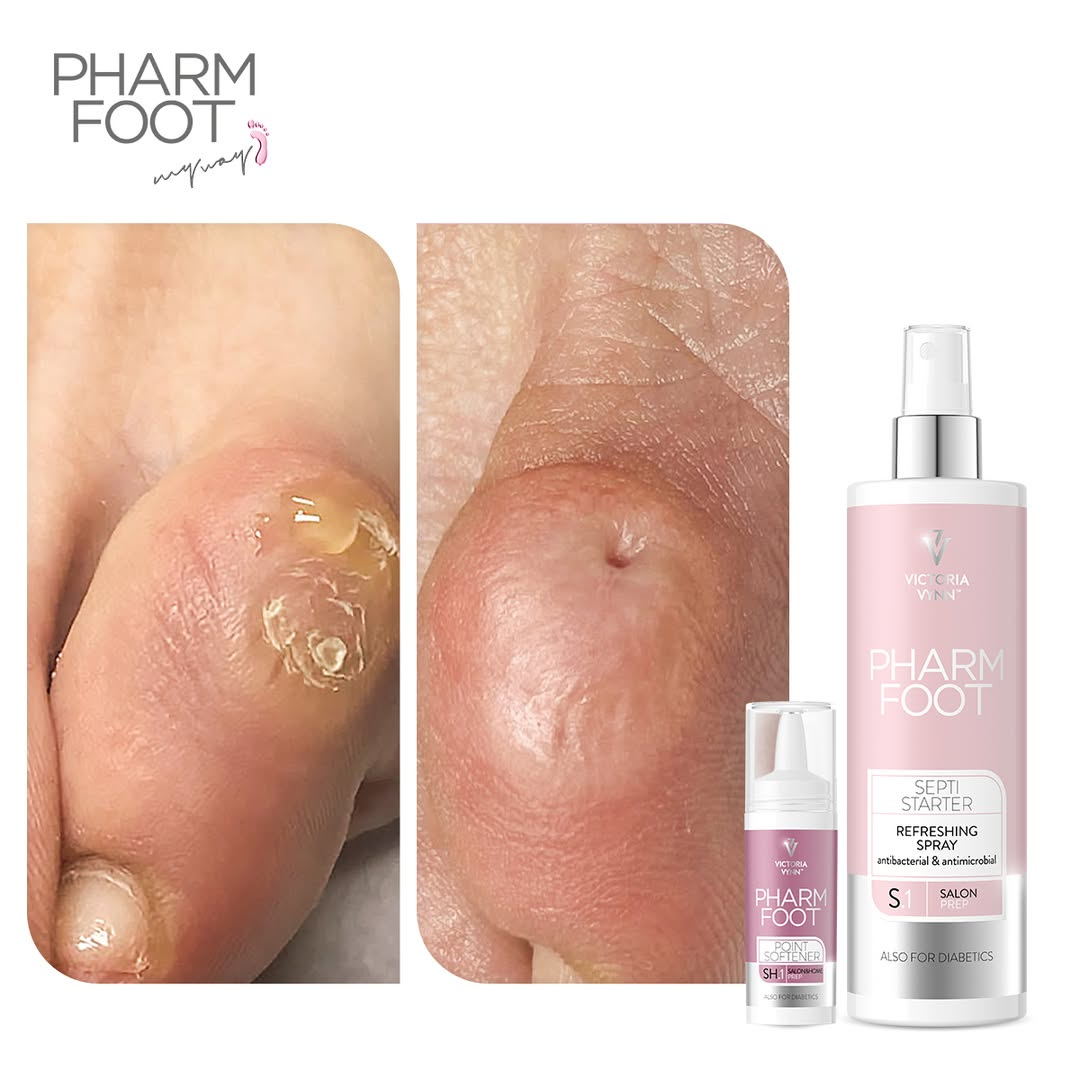 PHARM FOOT Komplekts varžacu noņemšanai