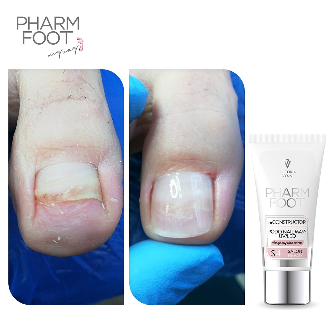 PHARM FOOT Реконструктор ногтей,  reConstructor Podo Nail Set UV/LED