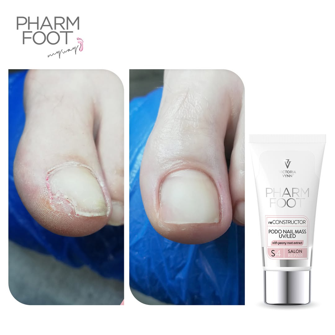 PHARM FOOT Реконструктор ногтей,  reConstructor Podo Nail Set UV/LED